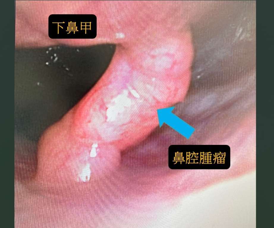 （圖／翻攝自耳鼻喉科醫師張弘 臉書　）