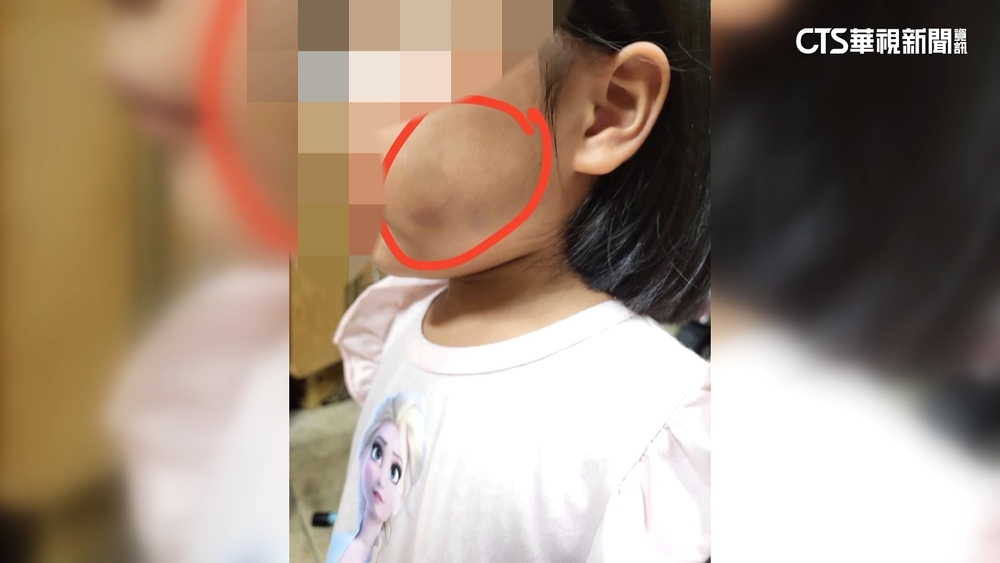 台南四歲女童多處傷　父指前妻同居男友下毒手