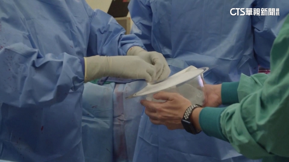 抽菸病患感染切雙肺　靠「乳房植體」維持心臟位置