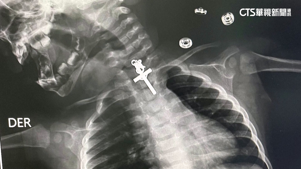 秘魯10月娃吞十字架墜飾　拍X光檢查嚇壞媽媽