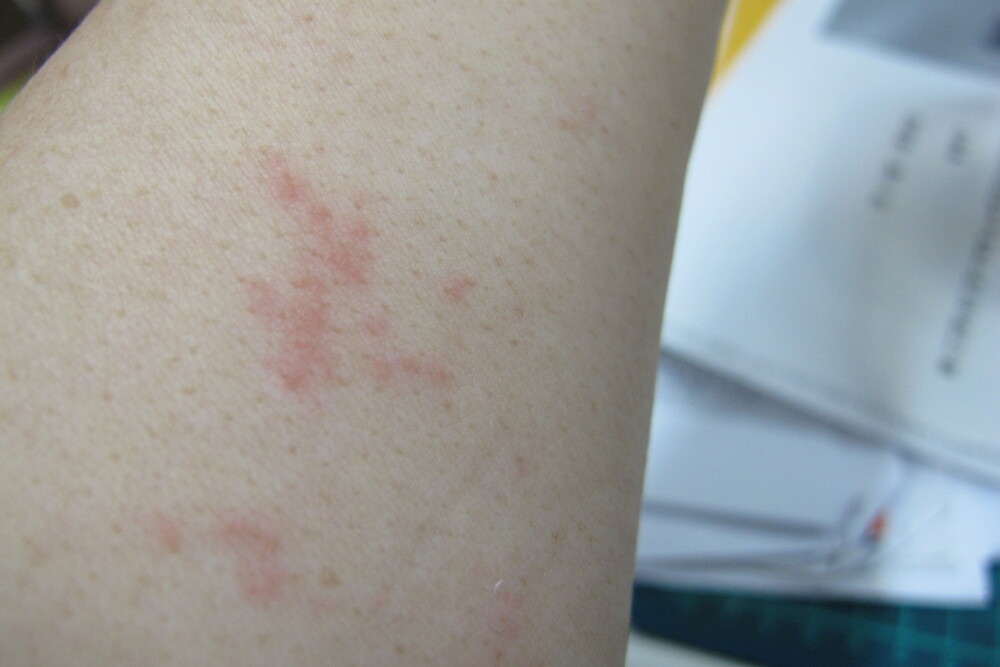 民眾擔心去南韓玩「帶臭蟲回國」　一票網推「白花油」：阿嬤級神物