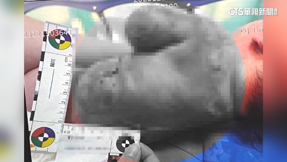 4星托嬰泡奶打翻熱水　嬰慘燙傷「體無完膚」