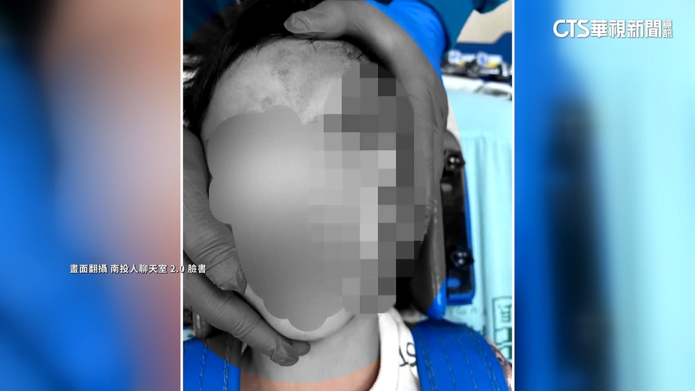 兒童公園磁磚剝落成利器　童撞到濺血縫6針