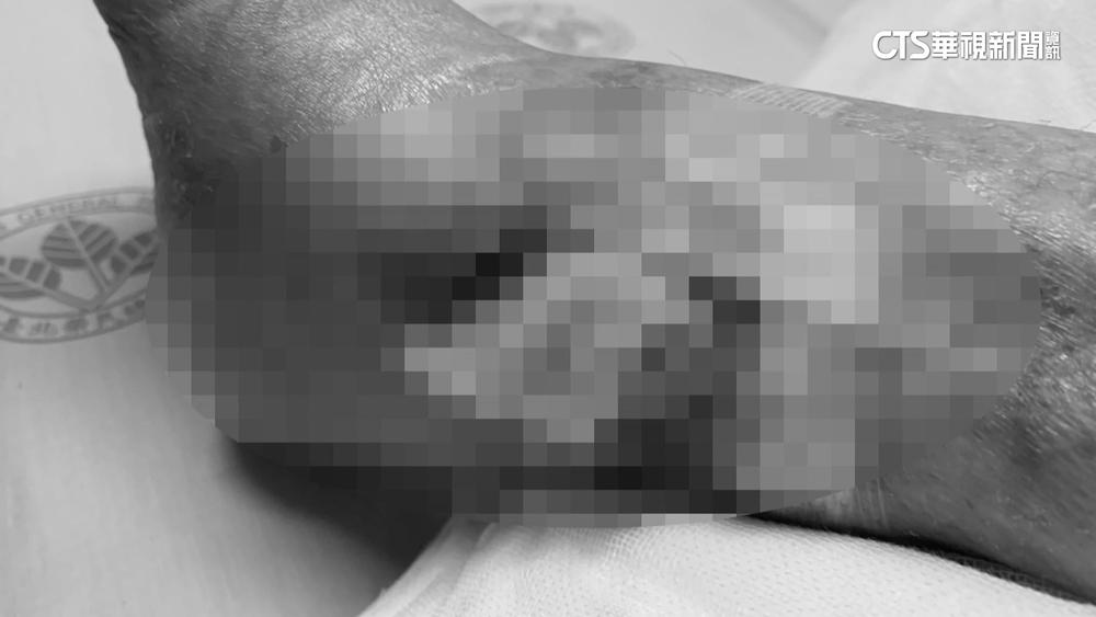 婦住安養院「骨折2次」家屬提告　院方：已進司法程序