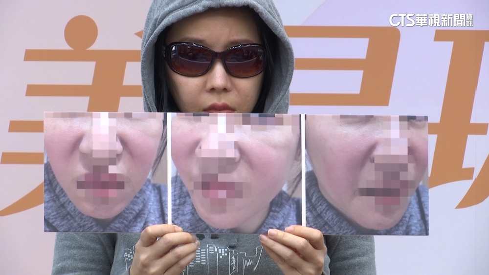 醫美「少女針」假貨盛行　紅腫發炎持續四年險毀容