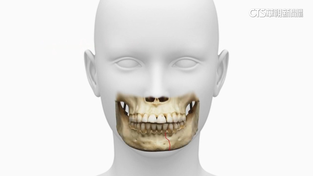 車禍「臉骨斷十截」！　醫療團隊「人骨拼圖」修復容貌