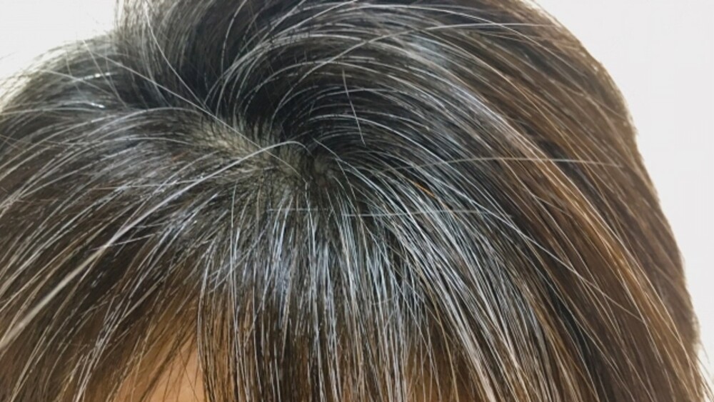 頭頂狂冒白髮？　醫：許多人忽略「2大要素」