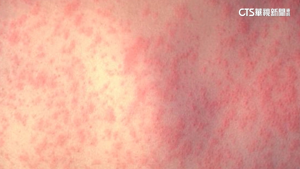美日麻疹疫情快速上升　加州急尋300名疑似接觸者