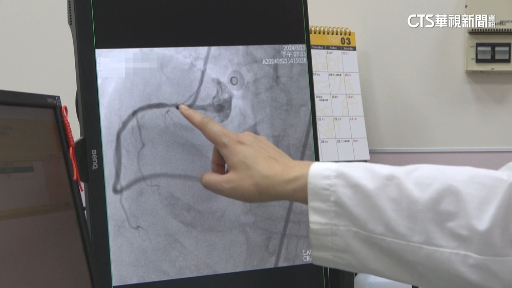 76歲參加白沙屯媽進香　疑水喝太少「心肌梗塞」