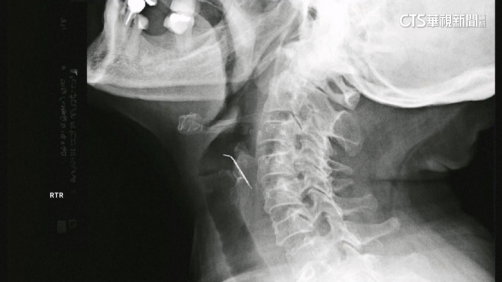 秘魯女子誤食鐵釘　劃破頸動脈吐血險送命