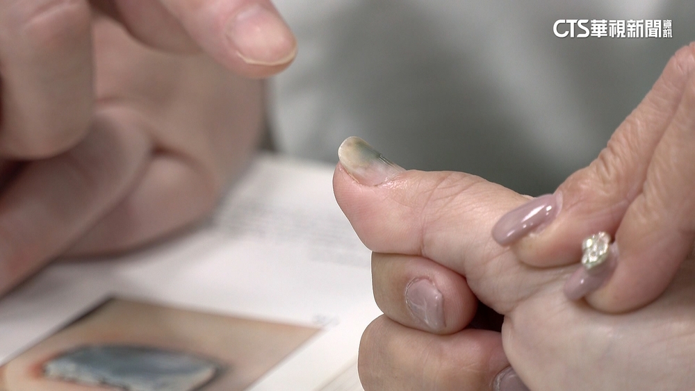 美甲變綠指甲　醫：甲床剝離「綠膿桿菌」入侵