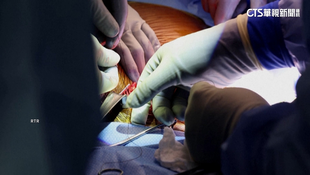 全球首例豬腎移植　美62歲男手術7週後亡