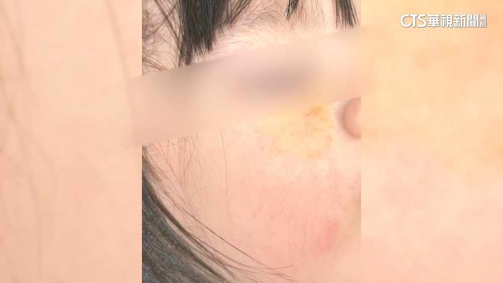 女兒遭寵物鴨啄傷眼家長提告　飼主：嘗試聯絡和解