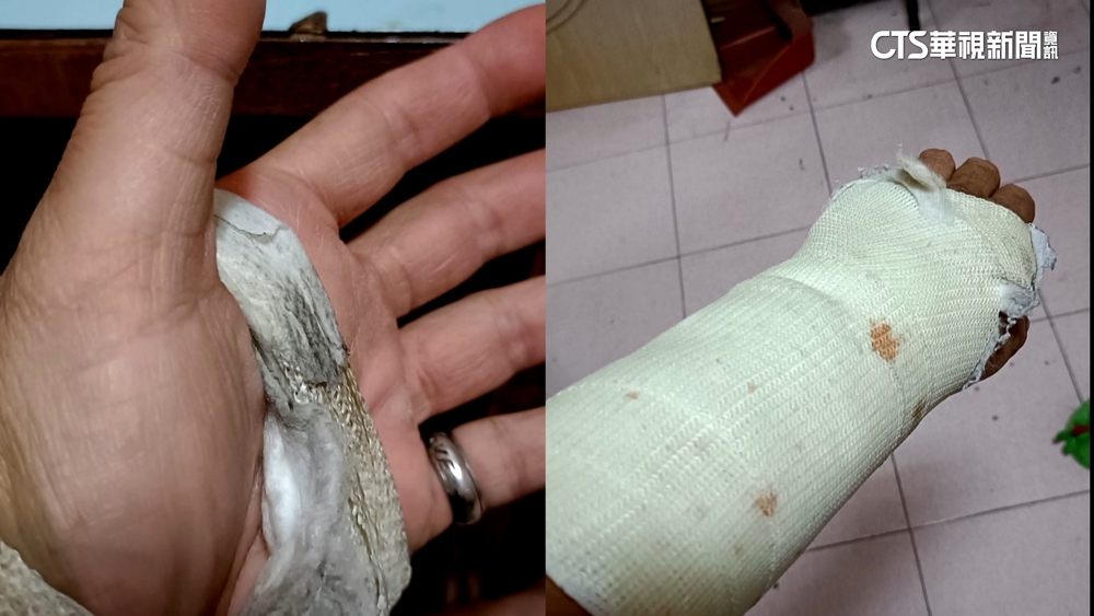 施工摔斷手驚覺「未保勞保」怒告　老闆：大家法院處理