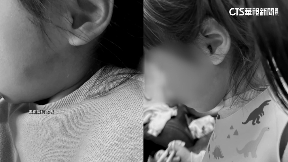 新竹幼兒園疑爆虐童　母控童臉.耳「紅腫瘀青」