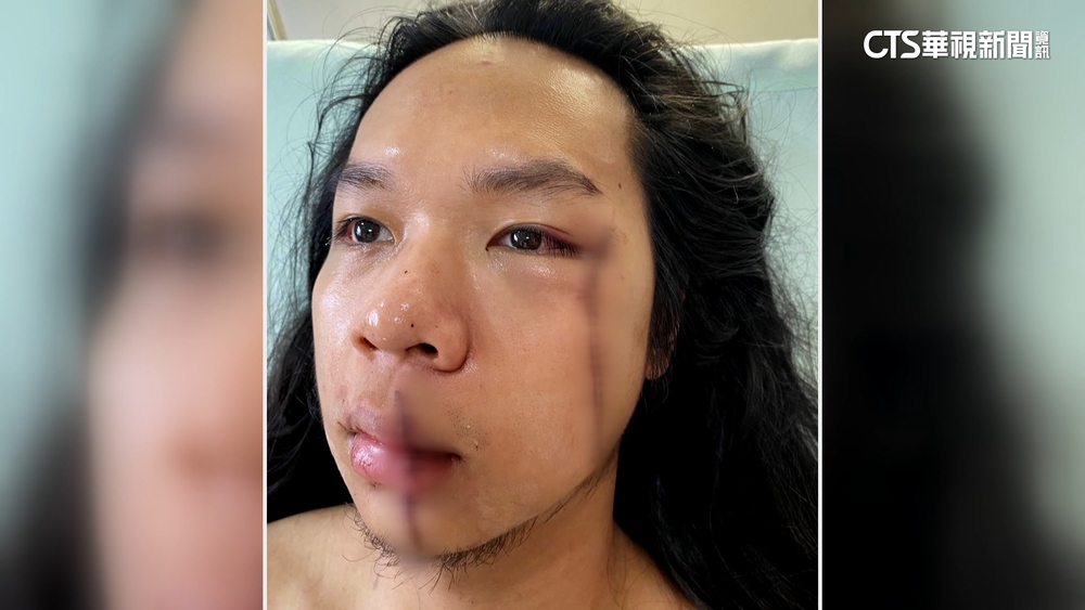 中捷馬尾哥臉部傷勢驚人！　「2道長疤」　網友心疼