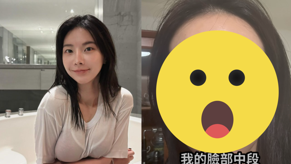 因臉部蜂窩性組織炎「腫到鼻子變形」　奎丁：差點登出這個世界