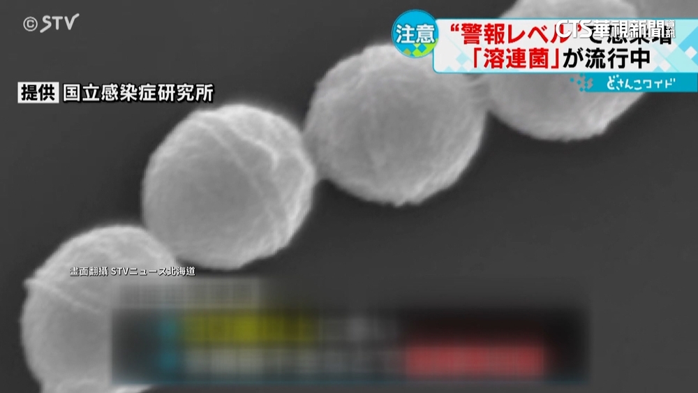 日本爆發「食人菌」危機　疾管署：持續監測中