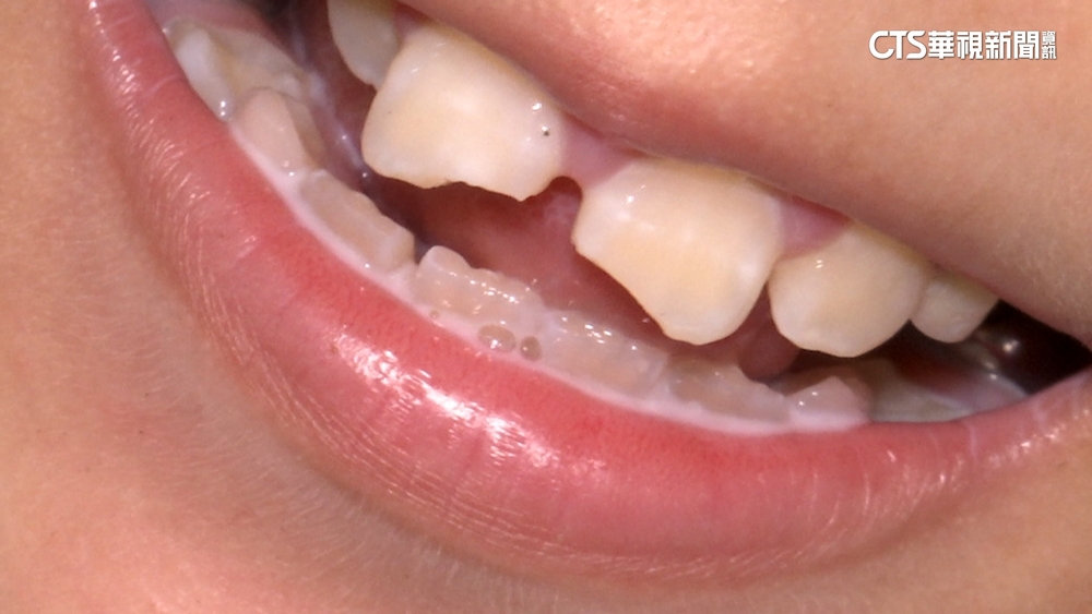 2童玩「騎馬打仗」害斷牙　協調未果家長告上警局