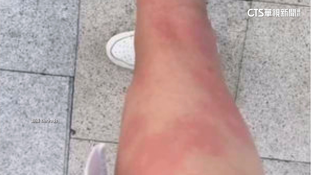 崩潰！　女被叮咬129包　高雄美術館：加強清消