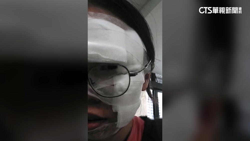 女控烤田螺熱油噴臉傷眼角膜　餐廳：賠償討論中