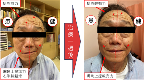 71歲男一早刷牙竟「顏面神經麻痺」 靠中醫針灸改善情況