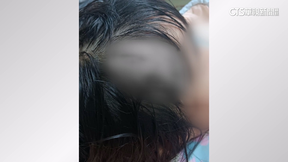 家長叫小孩水槍丟水池　女童遭砸中頭流血縫針