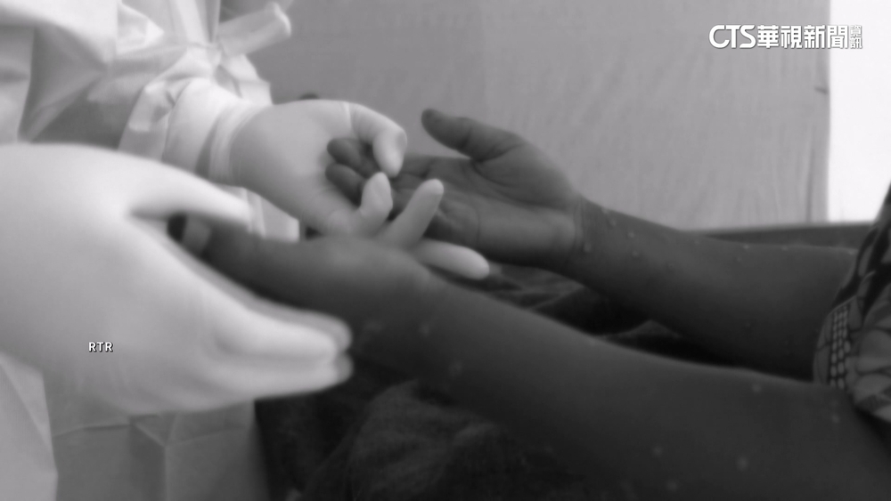 全球M痘疫情快速擴散　WHO：構成國際公衛緊急事件