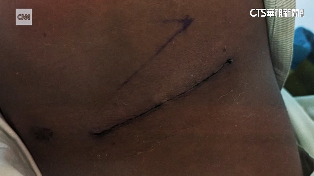 緬甸軍政變奪權經濟崩潰　人民賣腎換食物