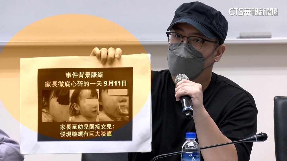 2歲童臉現齒痕.瘀青！　幼兒園遭控虐童　園方：待釐清