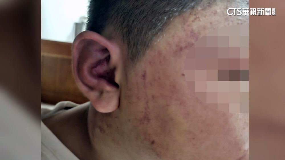 單車少年挨撞渾身傷　母控機車騎士幫忙擦藥就落跑