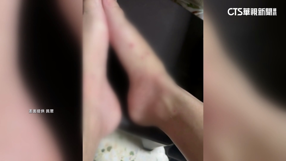 一晚六千多！　住阿里山民宿疑遭跳蚤狂咬　業者致歉