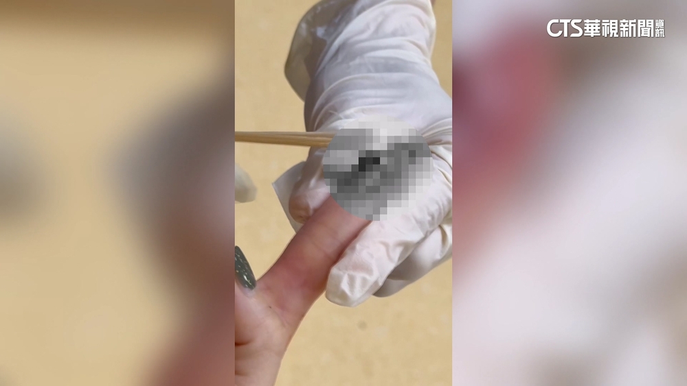 客控搭郵輪被夾傷須先付醫療費？旅行社：已協助退款