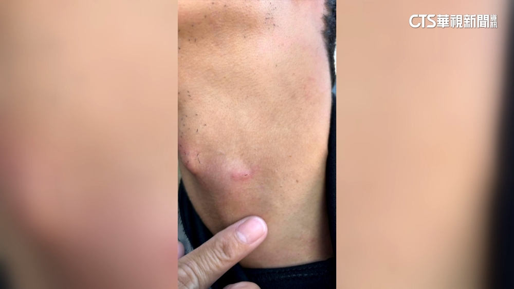 驚！　潛水教練遇釣魚鉤刺脖　潛水客籲：海域劃分