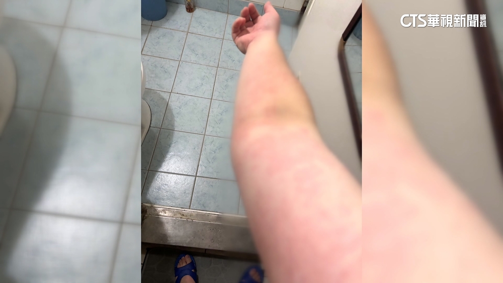 控吃壽司引發蕁麻疹　連鎖壽司：有致電關懷.嚴把關