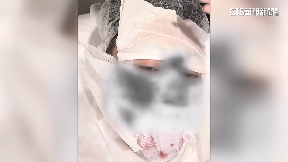 男子打皮秒臉滲血「燒燙傷」　專家：能量可能太強