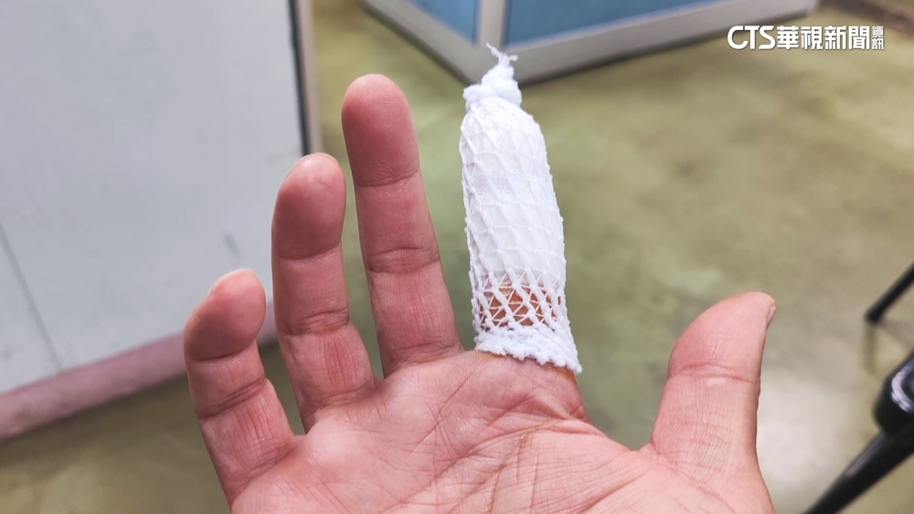 掃除遭玻璃刺傷！　手痛月餘就醫才知「碎片未清乾淨」