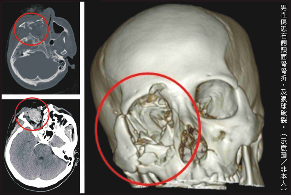 彰化男玩鞭炮「不慎炸傷臉」　右眼破裂復原之路漫長