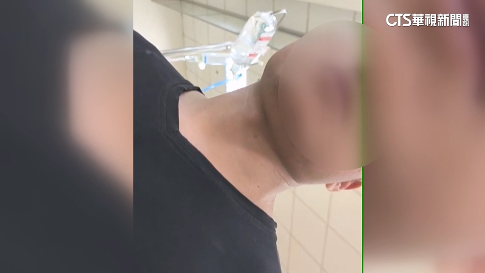 雙手燒傷黃姓工人女友探視！　工班回憶：爆炸後一片黑