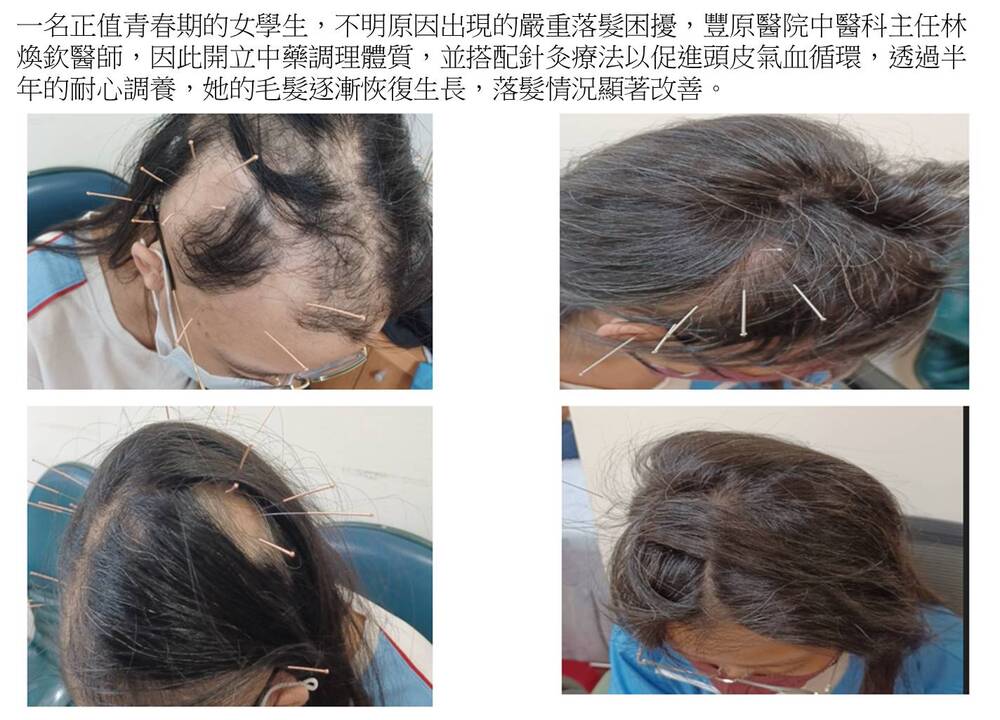 青春期少女「鬼剃頭」嚴重落髮　靠中醫調理重拾自信