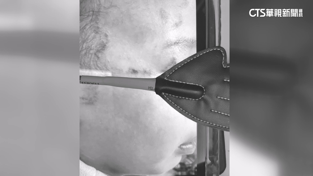 又傳虐童！　父控托育兒滿身傷　保母遭社會局撤照