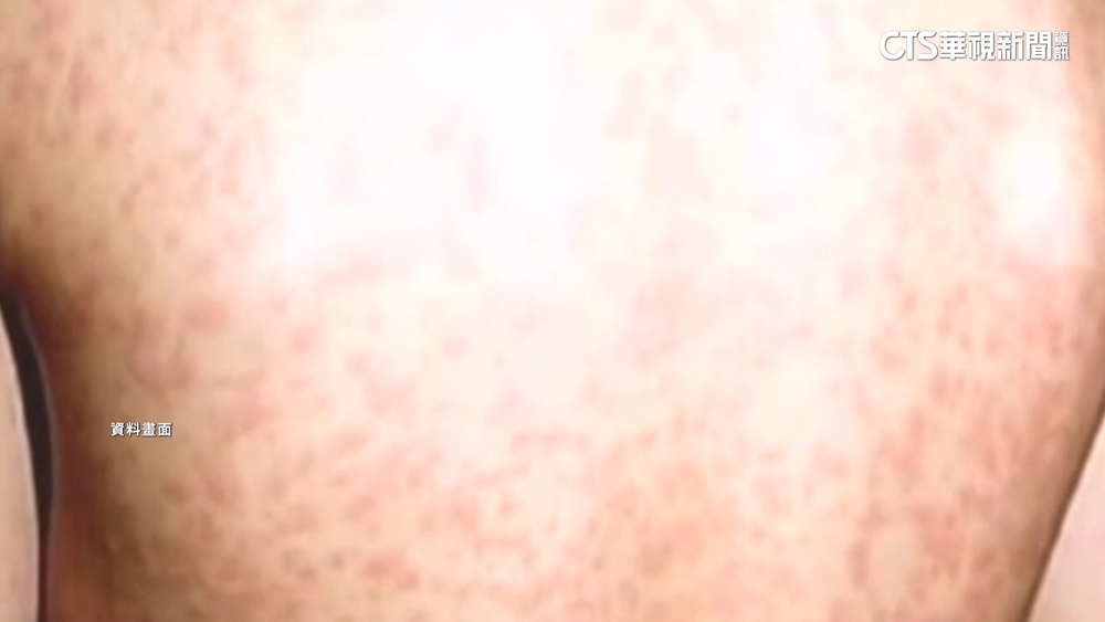北部麻疹個案南下台中　市府公布足跡匡列35人