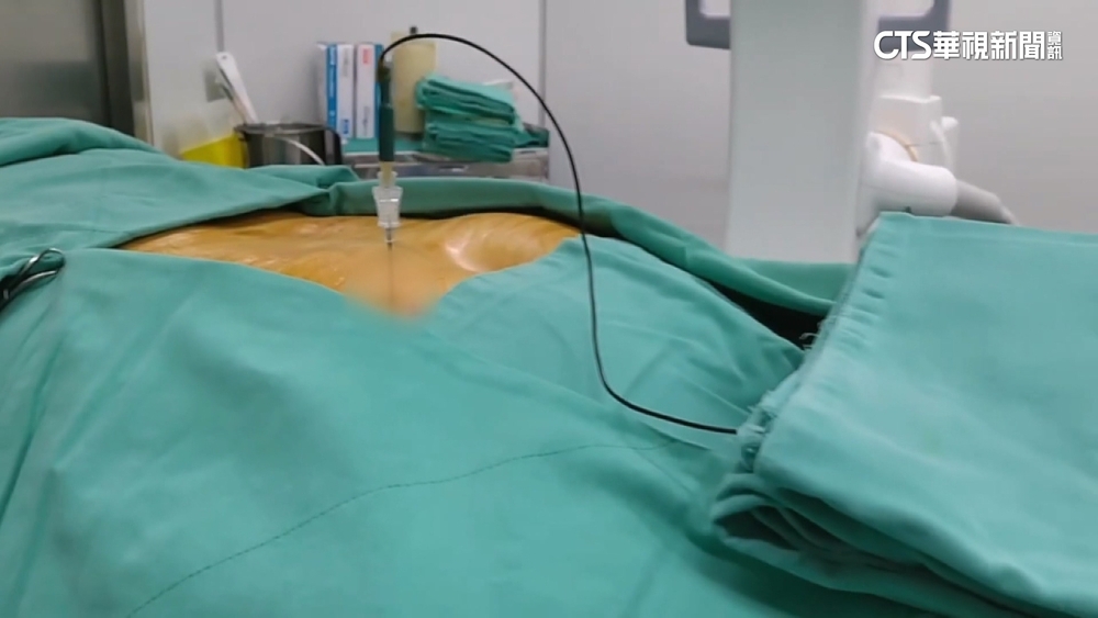 「脈衝電療池」藏風險？！　醫師：高齡者.心血管患者不宜