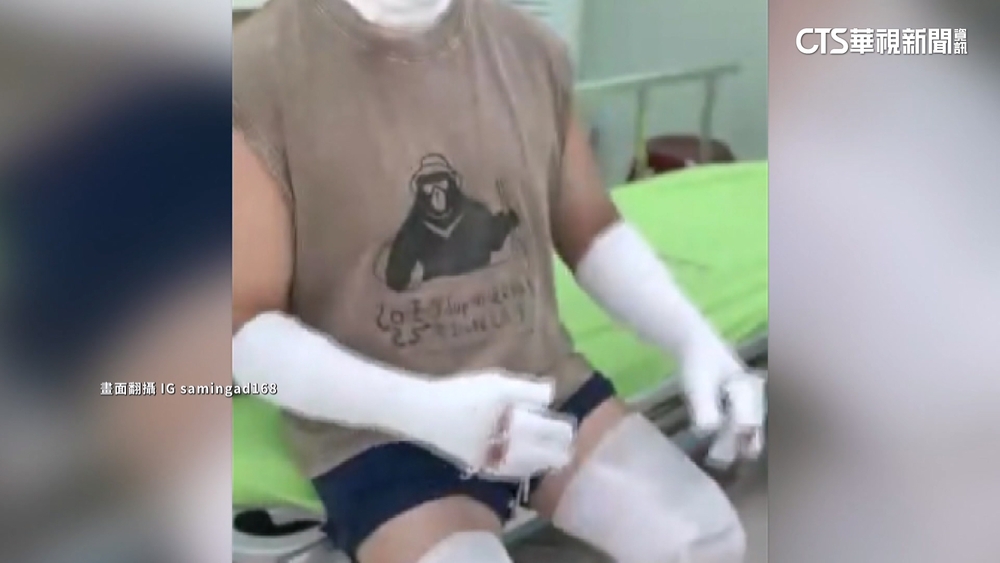 歌后擺攤遇氣爆　「夫二度燒傷」紀曉君心疼淚崩