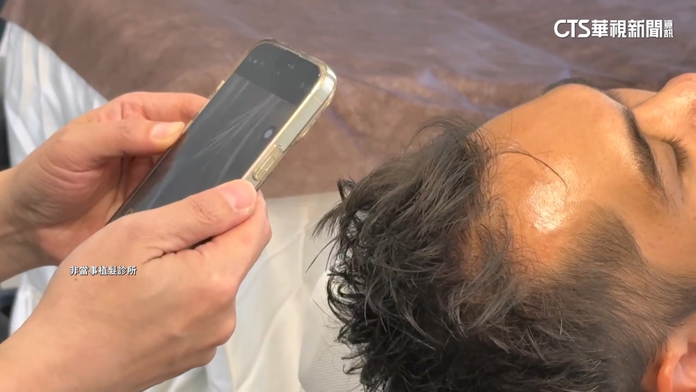 植髮效果不如預期！　男怒告診所　法院判決敗訴