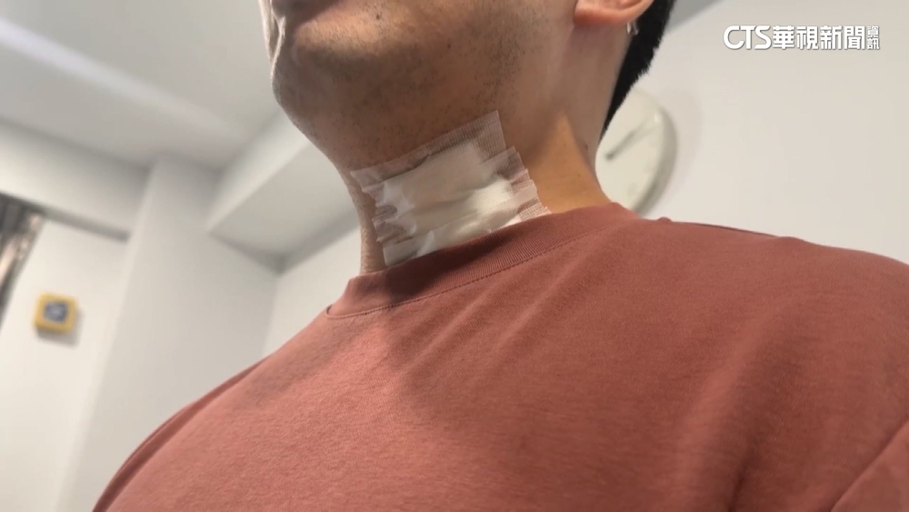 騎車返家遭金紙灰燼燙傷　警：恐涉過失傷害罪