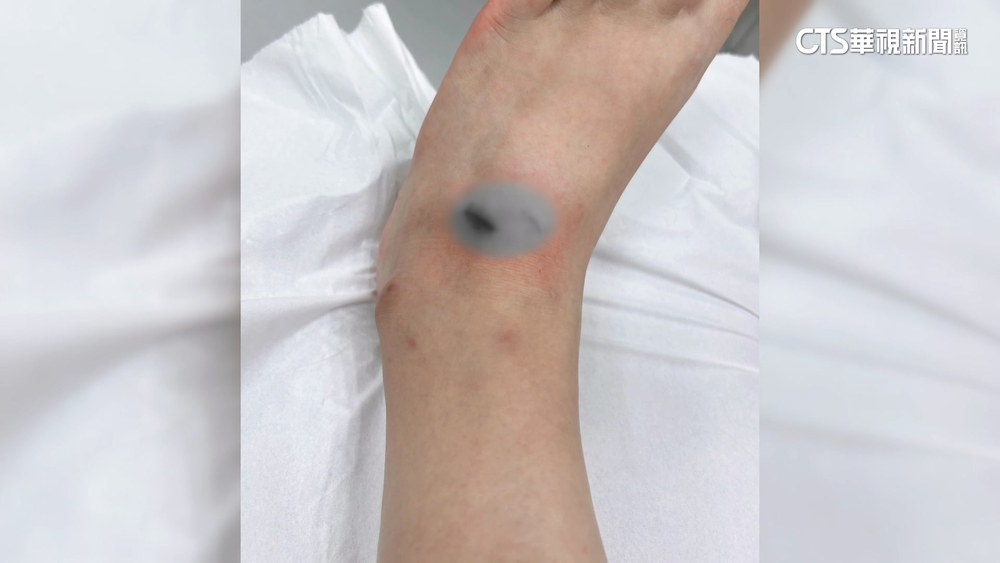 狗咬傷腳縫2針！　女怒告飼主態度不甩　動保處開罰