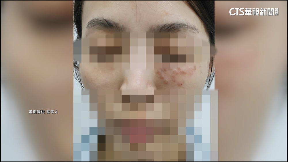 車模打牛奶針後喪命！　名醫再遭控「打電波」害灼傷