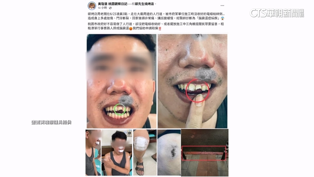 走人行道被絆倒摔斷牙　議員：桃市府施工失職