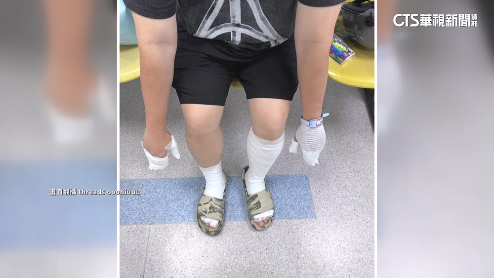 殺蟲劑誤噴捕蚊燈閃燃　民眾手腳二度燒燙傷送醫